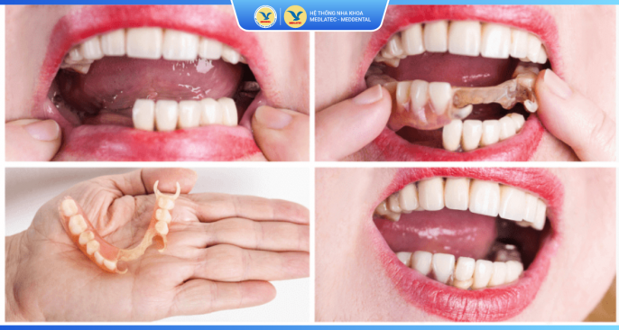 Bảng giá dịch vụ hàm tháo lắp 